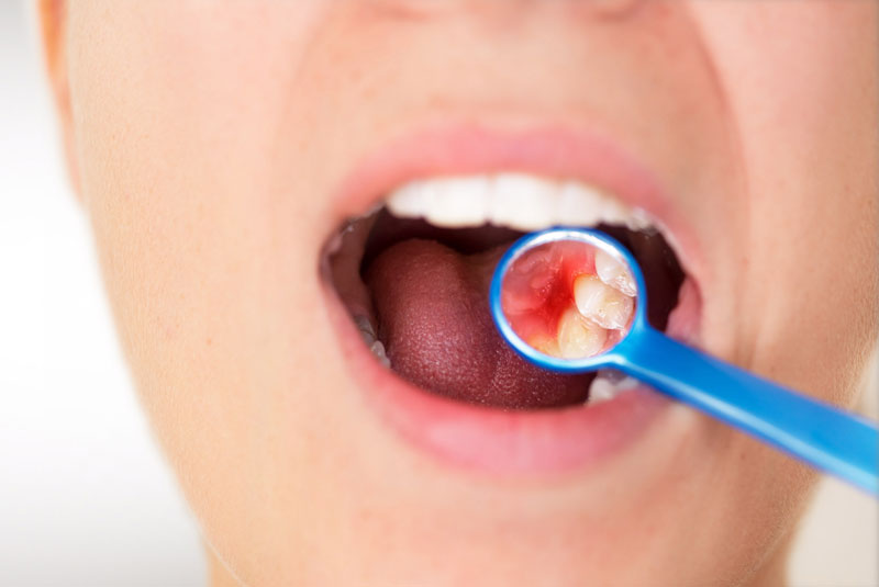 Dental Patient In Need Of Gum Disease Treatment