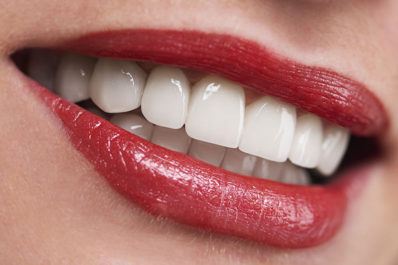 Bright White Teeth After Professional Tooth Whitening