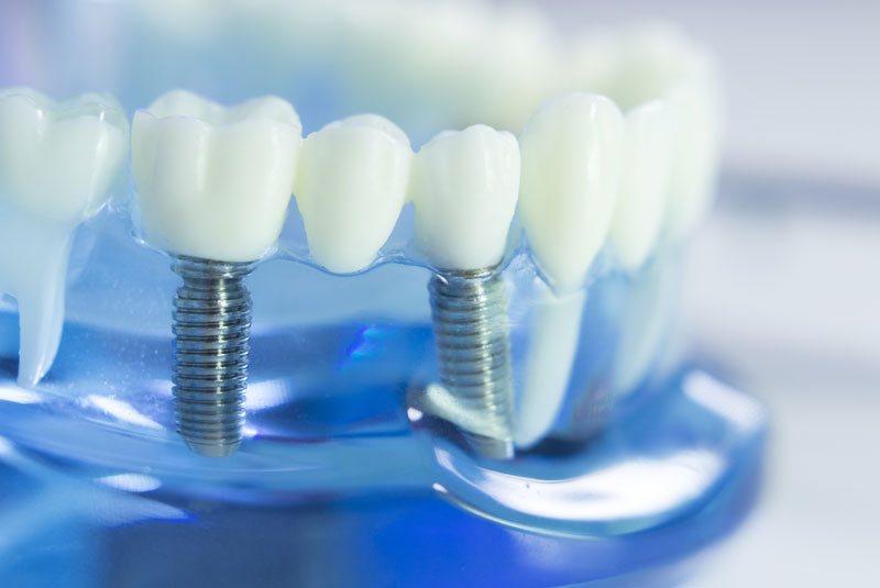 a model of a dental implant for a prosthodontist tooth restoration procedure