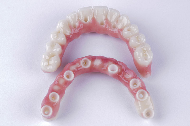 an implant model showing two zirconia arches