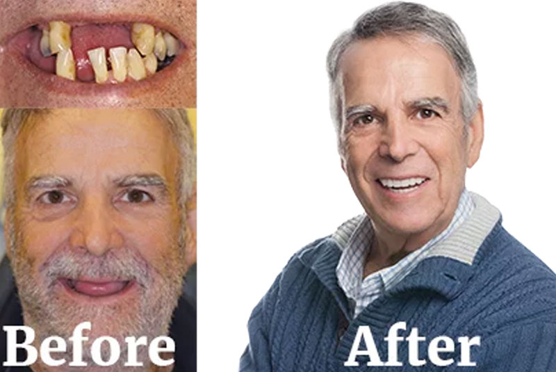 before and after dr ferrier teeth xpress