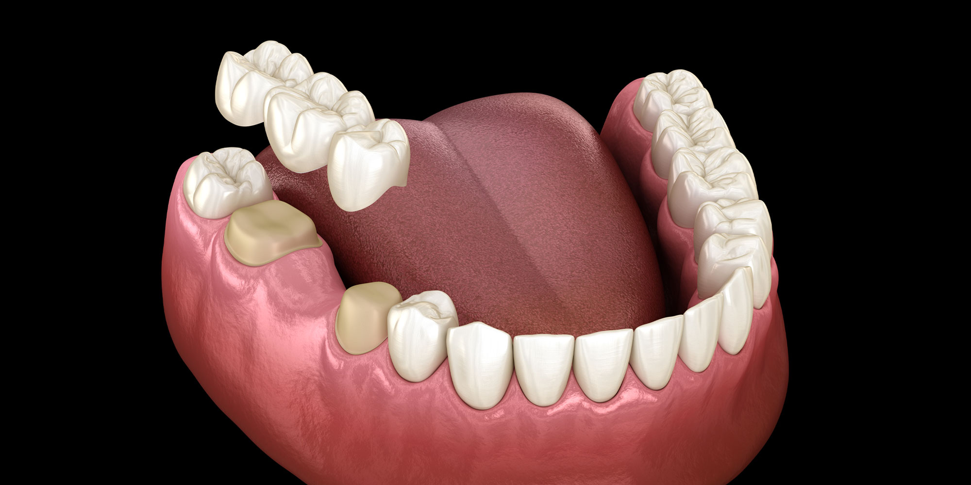 dental crown 3d model rendered