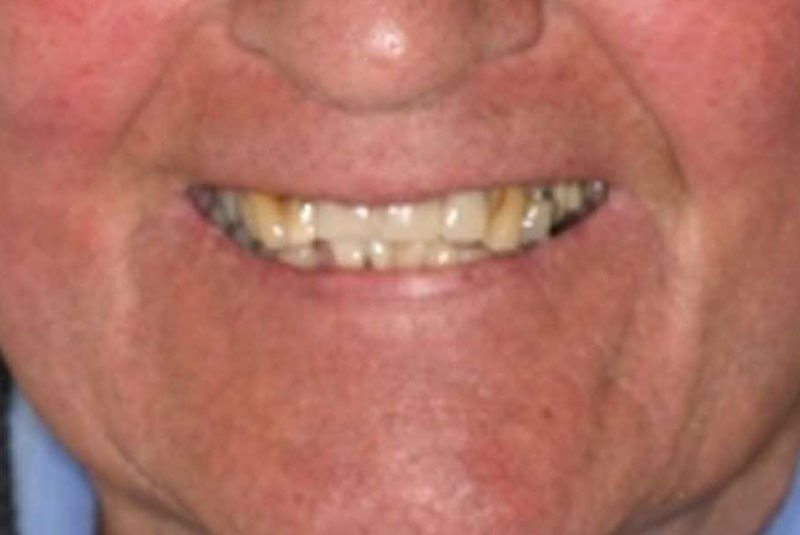 full mouth implant before and after