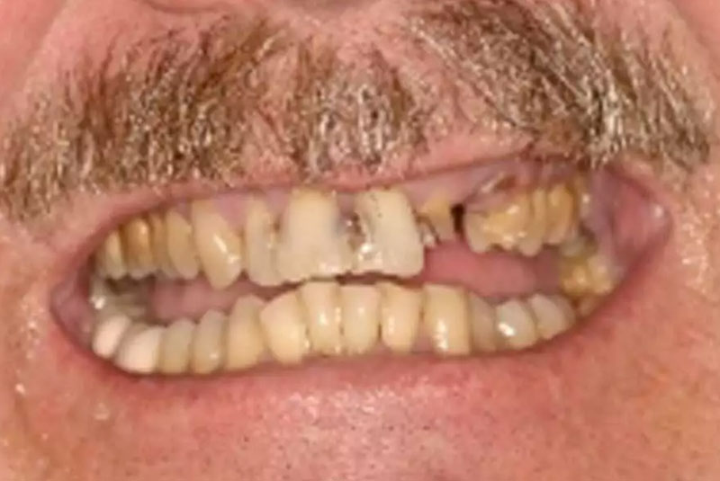 full mouth implant before after