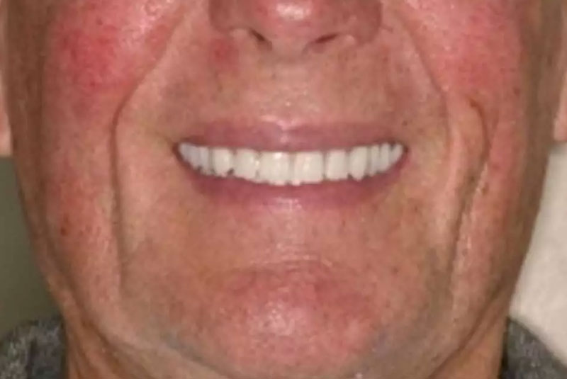 full mouth implants before after