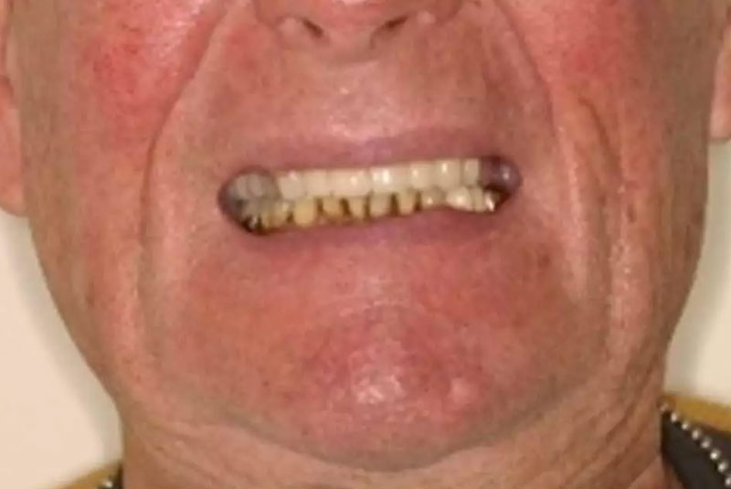 full mouth implants before after