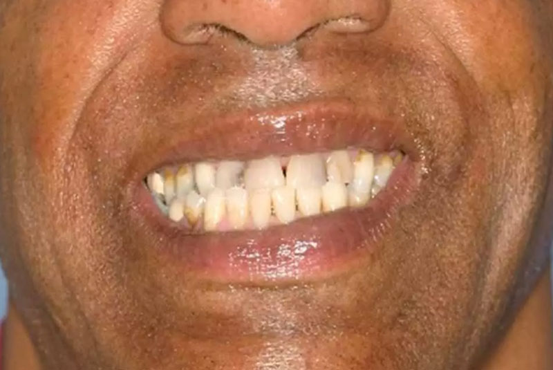 full mouth implant before after