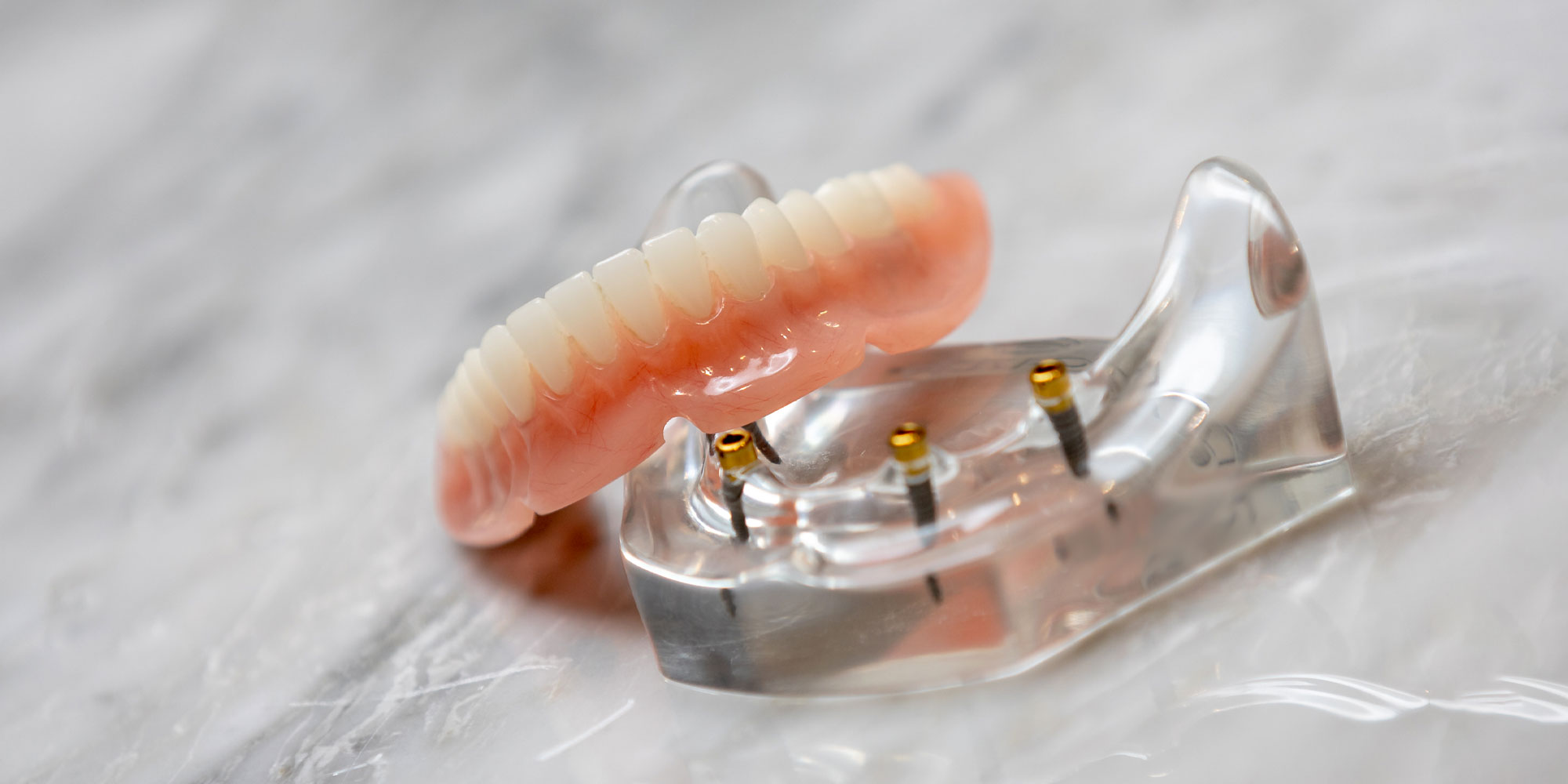 implant supported denture model being displayed