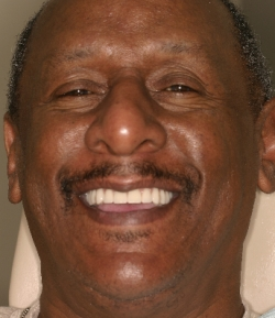 man smiling after all-on-4 procedure