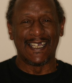 man smiling before all-on-4 procedure