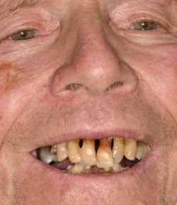 man's smile before all-on-4 procedure