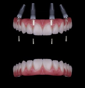 All-on-4 Dental Implants illustration