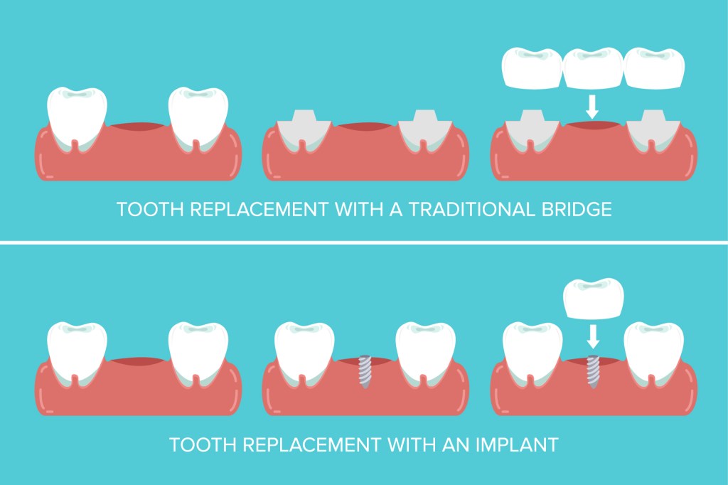 dental implants vs. dental bridges illustration